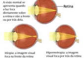 miopia.jpg